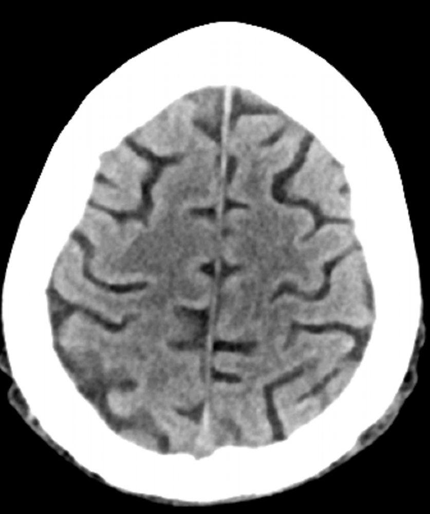 Normaler Kopf-CT-Aufnahme (Erwachsener, Alter 74) – Folie 1
