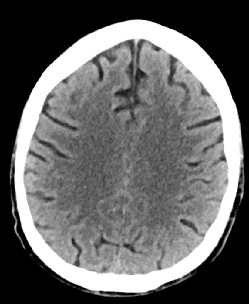 Normaler Kopf CT-Scan (Erwachsene, Alter 74) – Folie 2