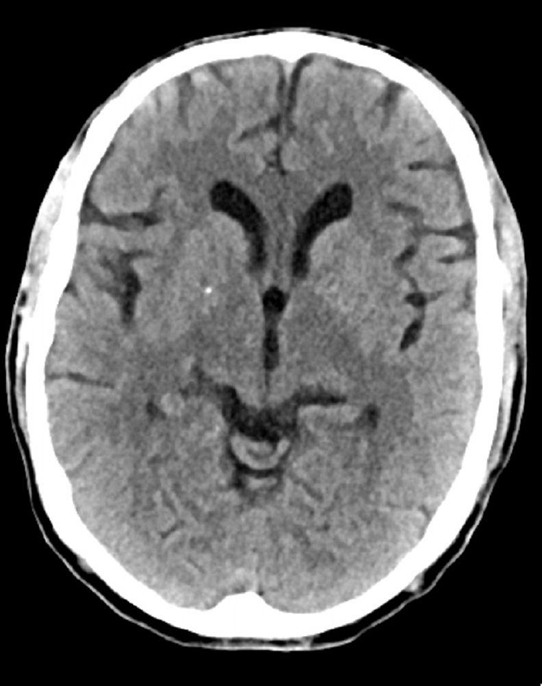 Normaler Kopf CT-Scan (Erwachsene, Alter 74) – Folie 6