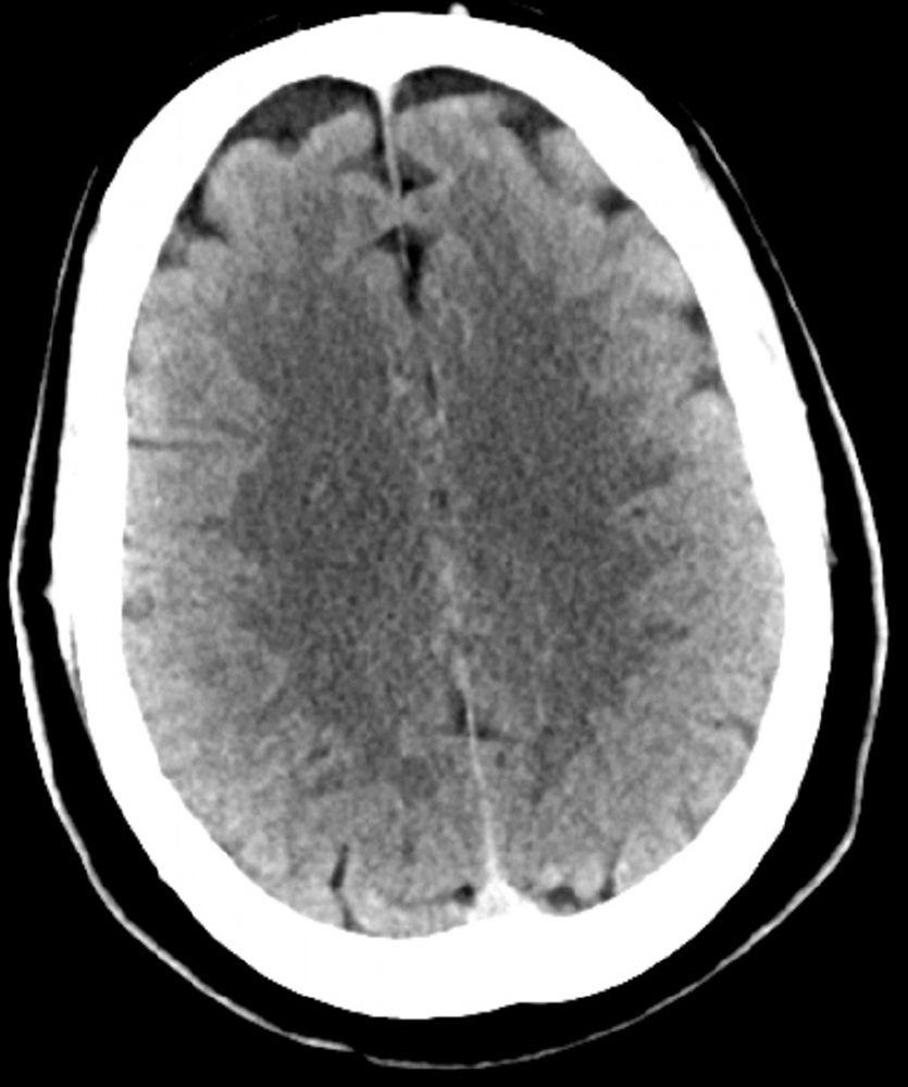 Normaler Kopf CT-Scan (Erwachsene, Alter 30) – Folie 2