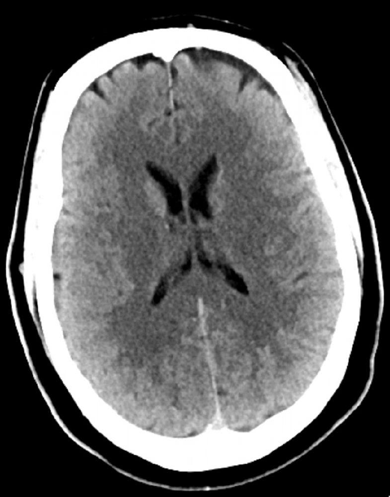 Normaler Kopf CT-Scan (Erwachsene, Alter 30) – Folie 4