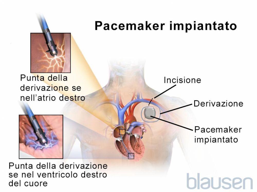 Pacemaker impiantato