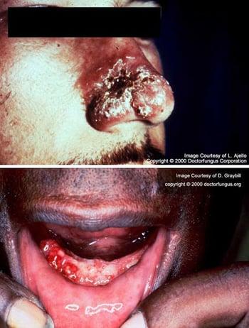 Paracoccidioidomicosis (úlceras mucocutáneas)