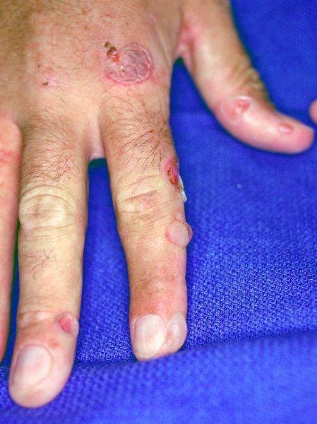 晩発性皮膚ポルフィリン症（手指）