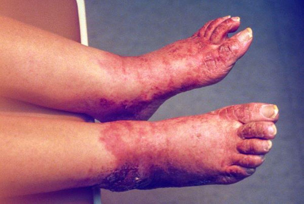 Thay đổi ở da do bệnh pellagra (bàn chân)