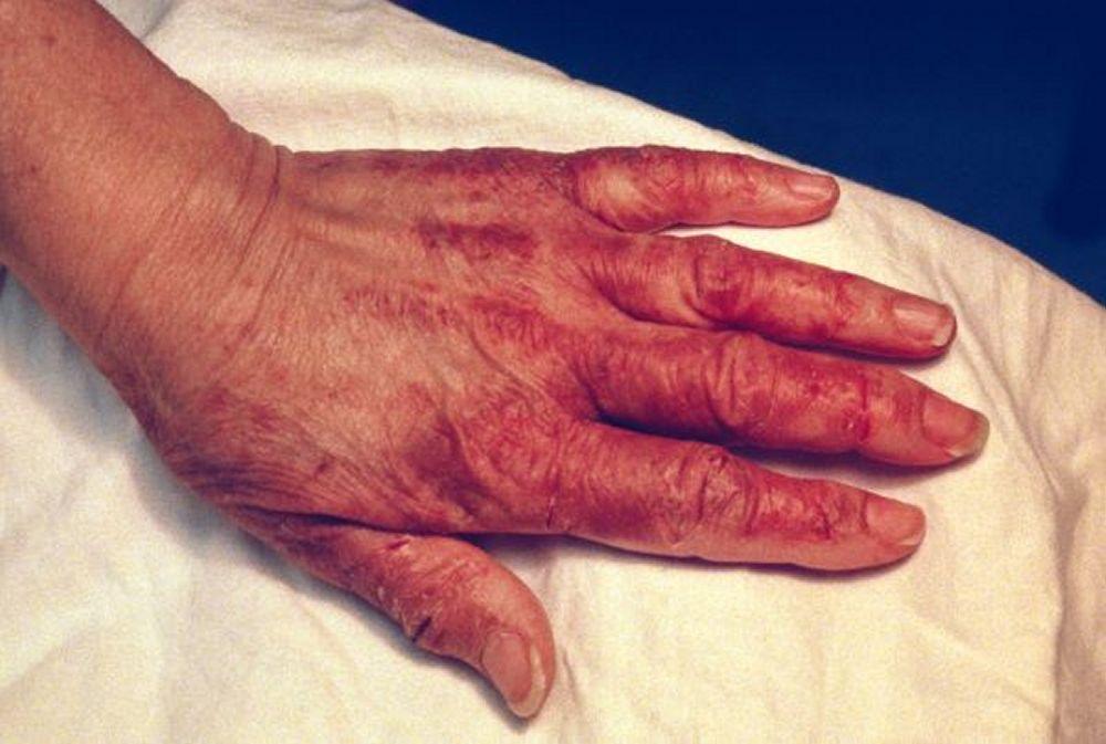 Thay đổi ở da do bệnh pellagra (bàn tay)