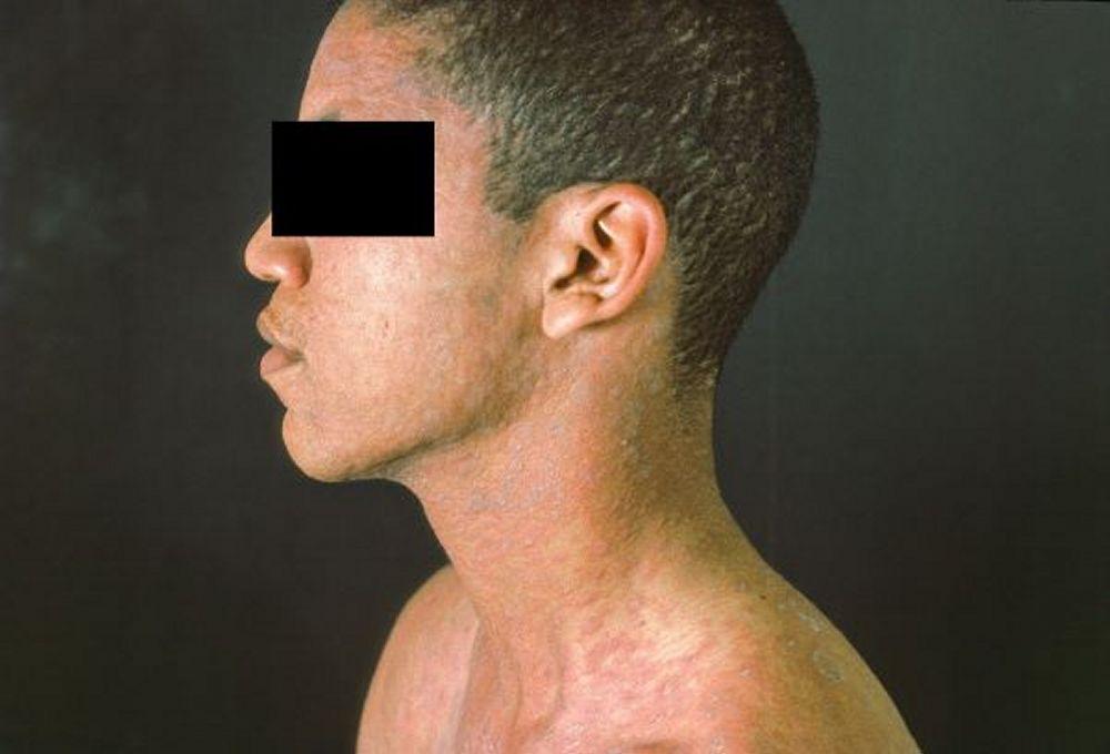 Pitiriasis rosada (Cabeza y torso)