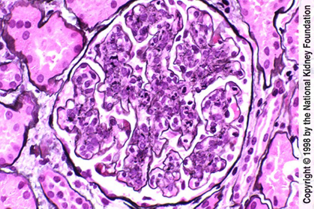 Постинфекционный гломерулонефрит (повышенное содержание паренхиматозных клеток с нейтрофильной инфильтрацией)