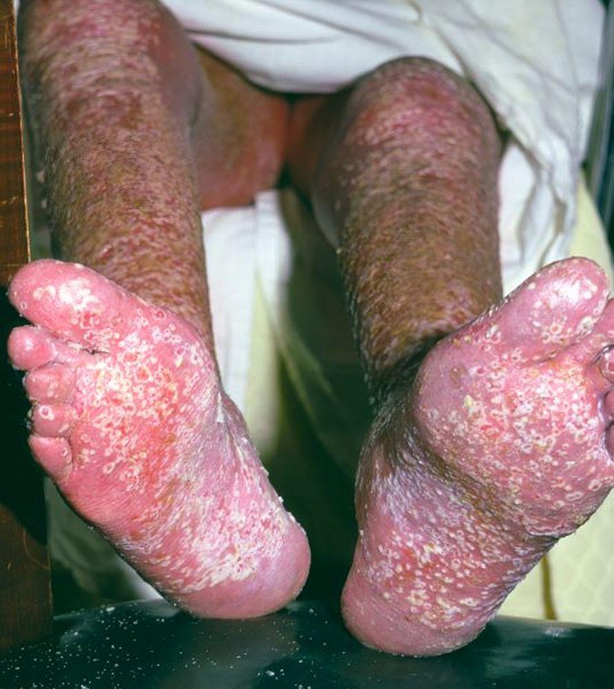 Bệnh vẩy nến thể mụn mủ (bàn chân)