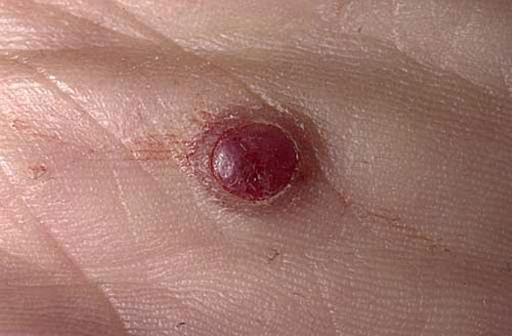 Granuloma pyogenicum (Handfläche)