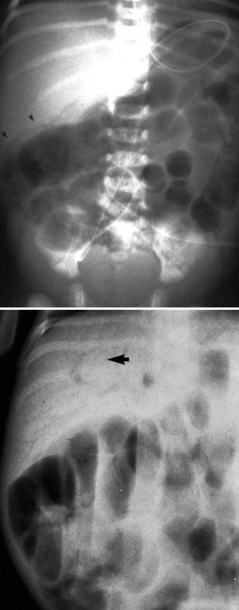 Đặc điểm X-quang của viêm ruột hoại tử