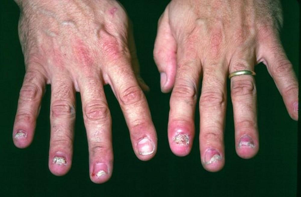 Reactive Arthritis (Nails)