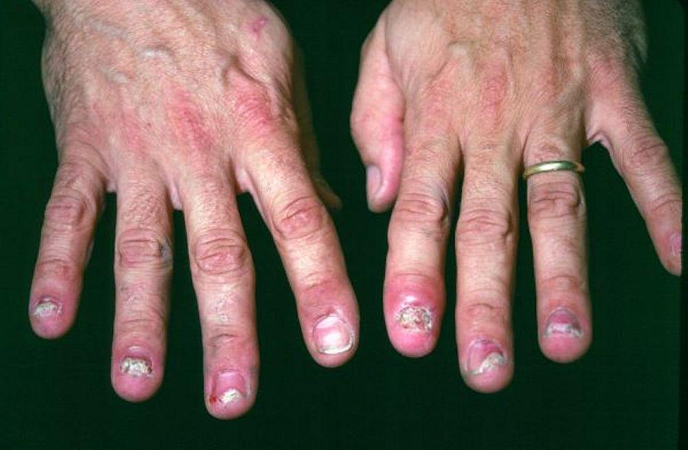 Artritis reactiva (Uñas)