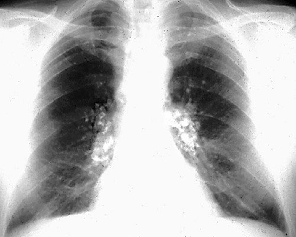 Silicosis—Eggshell Calcifications