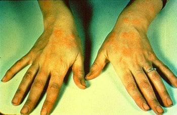 Dermatitis numular (manos)