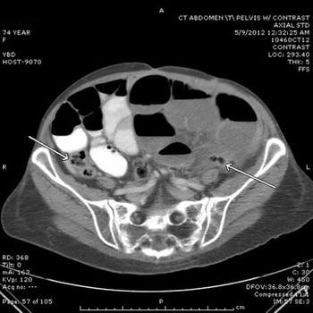 CTで見た小腸閉塞