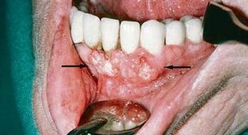 Squamous Cell Carcinoma (Gingival Lesions)