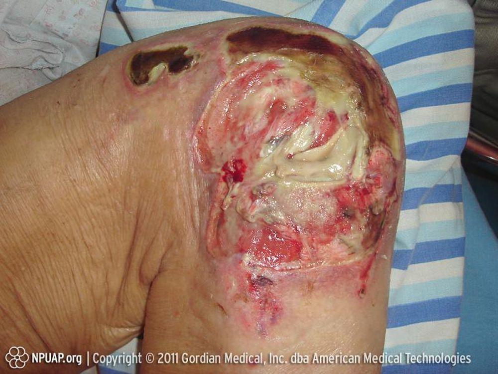 Lesión por decúbito estadio 4 (rodilla)
