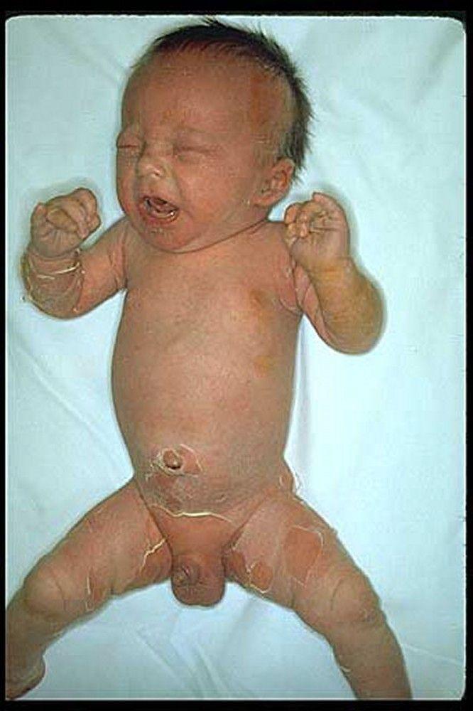 Staphylococcal Scalded Skin Syndrome (Infant)