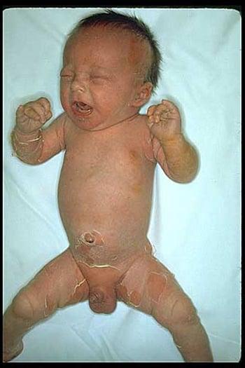 Sindrome della cute ustionata da stafilococco (neonato)