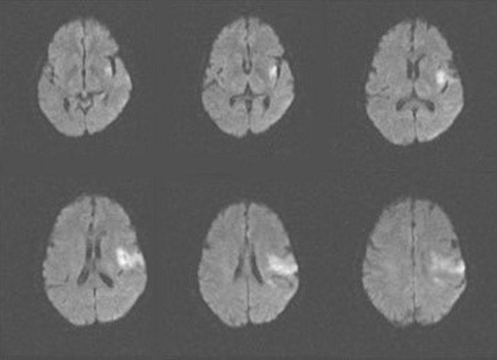 Đột quỵ do thiếu máu não cục bộ cấp tính ở thùy đảo và thùy trán bên trái (MRI)