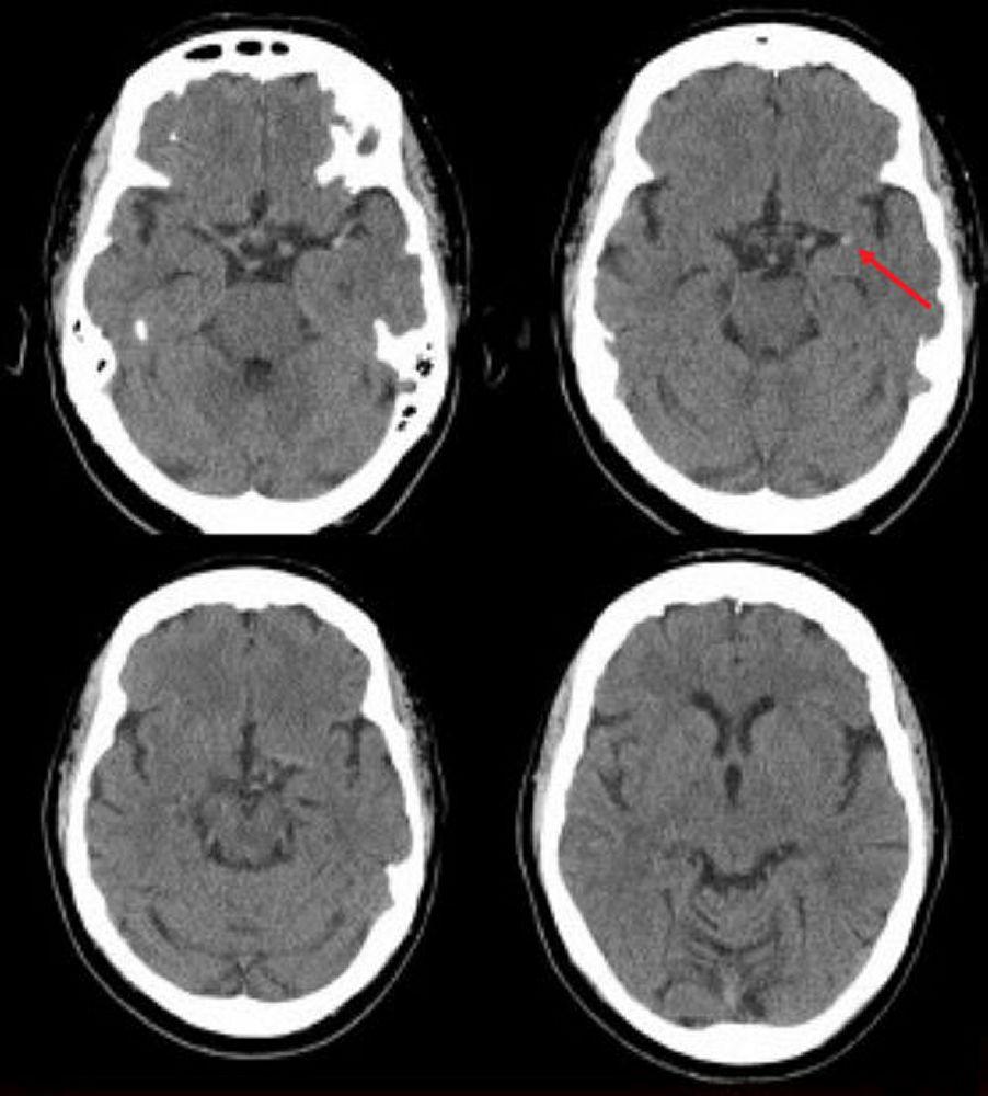 Acidente vascular encefálico isquêmico na artéria cerebral média esquerda (TC)