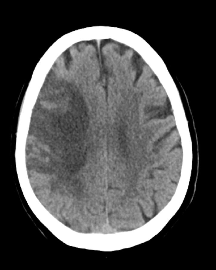 亜急性中大脳動脈梗塞（CT）