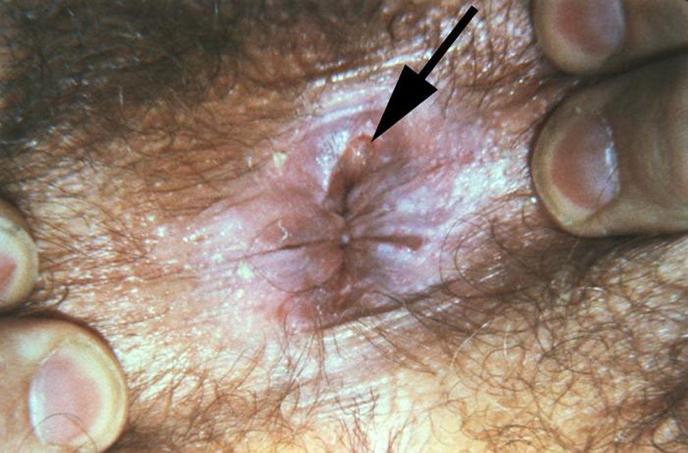 Sifilide, primaria (sifiloma anale)