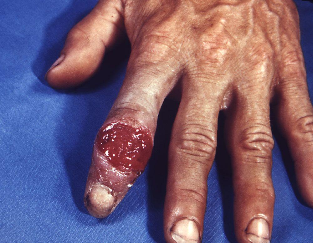Сифилис – первичный (шанкр на пальцах)