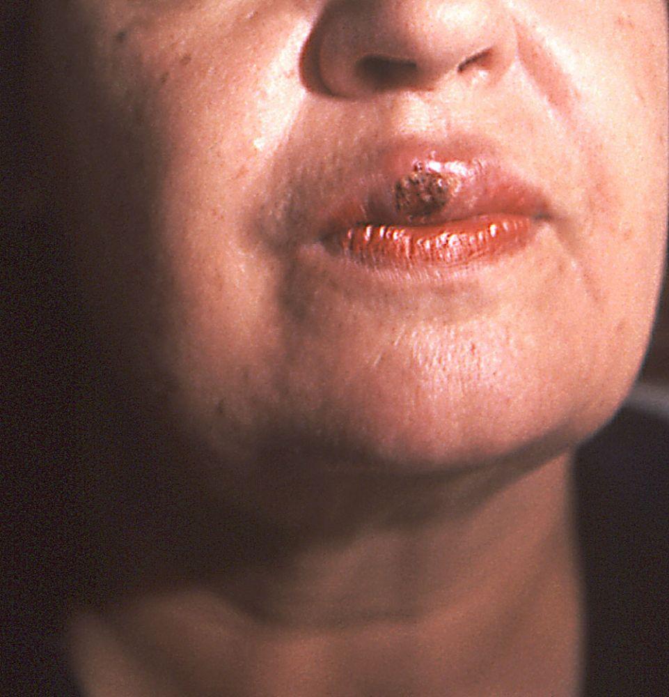 Sifilide, primaria (sifiloma della bocca)