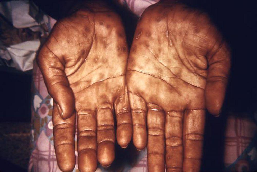 Sifilide, secondaria (mani)