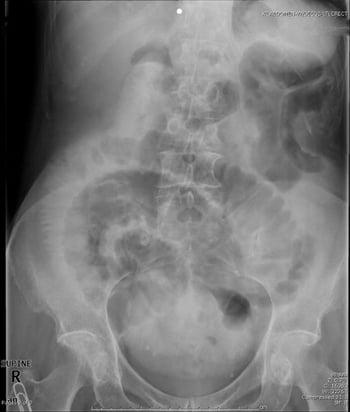 Obstruktion des Dünndarms (Röntgenbild in Rückenlage)
