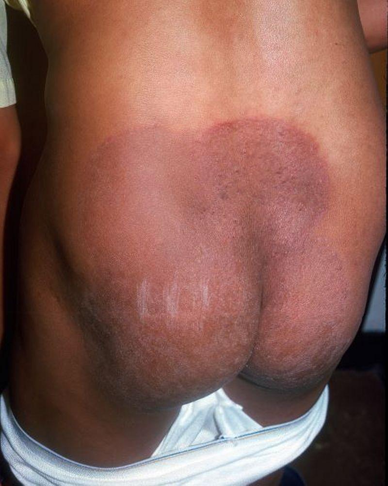Bệnh nấm da thân ở mông