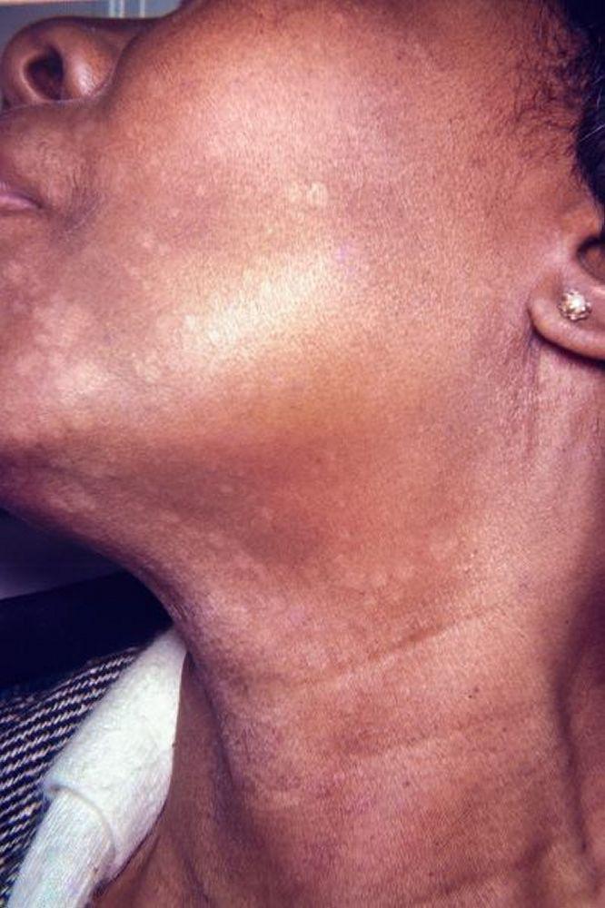 Bệnh lang ben có các dát và mảng giảm sắc tố trên mặt và cổ