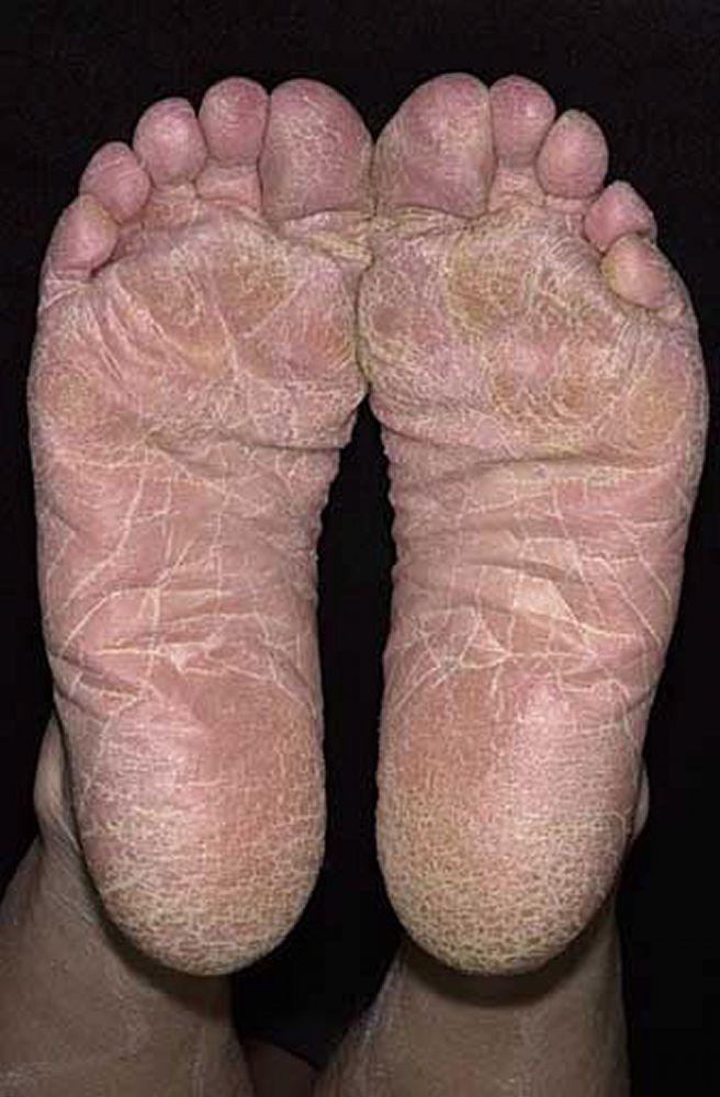 Nấm da bàn chân (phân bố kiểu moccasin)