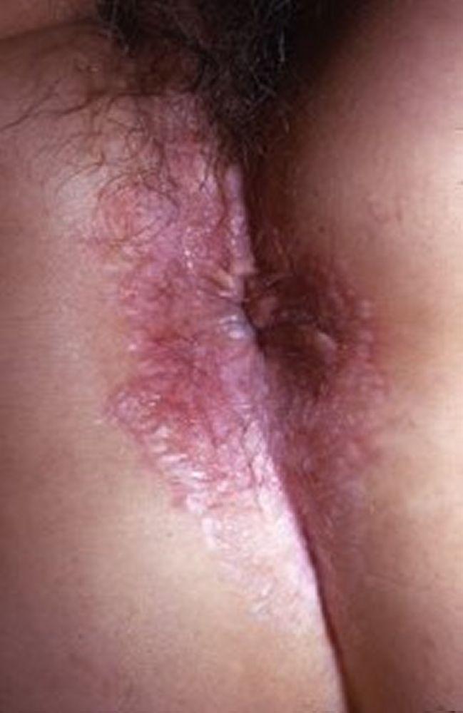 Lichen sclerosus (perianale Befunde)