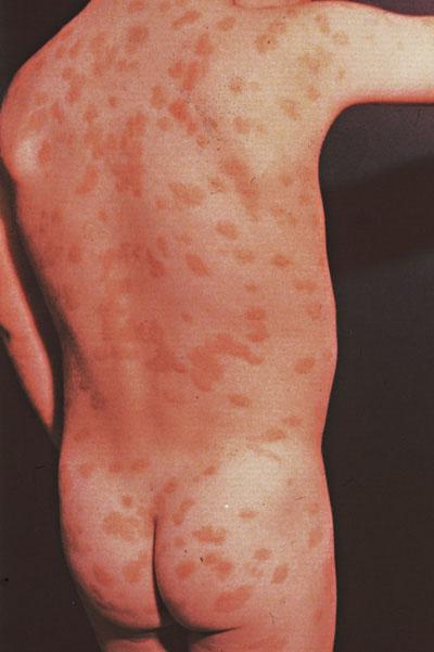 色素性蕁麻疹