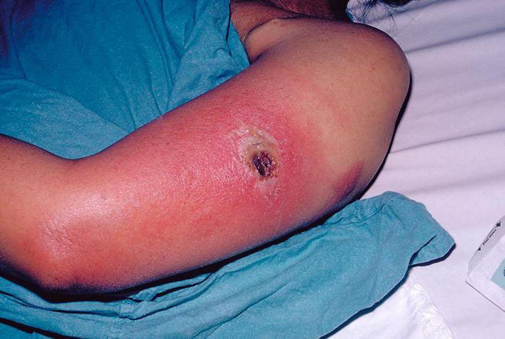 Bệnh đậu mùa – Tiến triển (tổn thương da được mô tả là Vaccinia Necrosum)