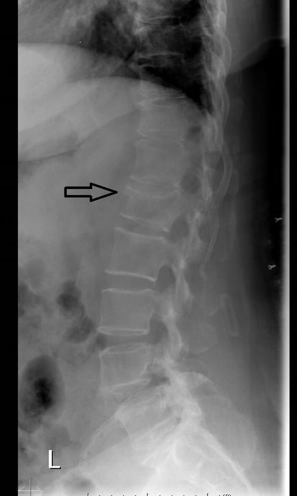 Fratura por compressão vertebral (radiografia)