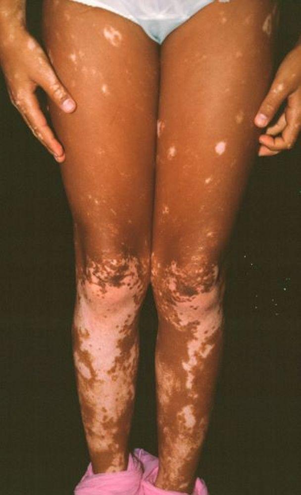 Vitiligo der Unterschenkel