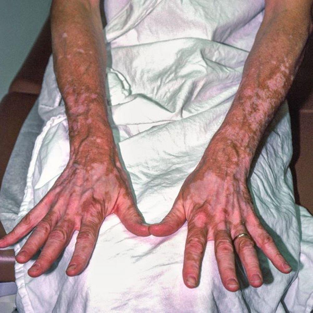 Vitiligo (mãos e braços)