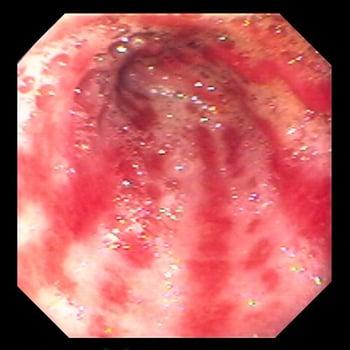 Ectasia vascular do antro gástrico (estômago em melancia)